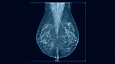 人工智能乳腺癌筛查技术将后期诊断率降低12%