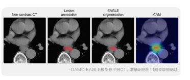 阿里达摩院发布食管癌 AI 模型 DAMO EAGLE：不插管，平扫 CT 就能查早癌